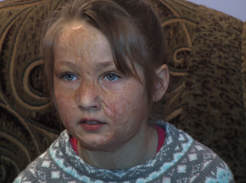 8-latka potrzebuje nowych dłoni i twarzy - grafika