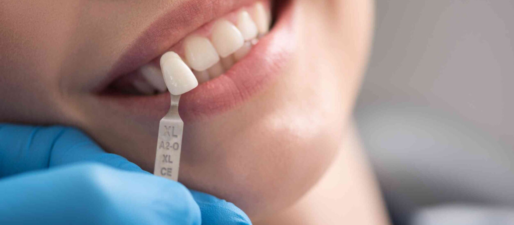Proces aplikacji licówek: czego możesz się spodziewać podczas wizyty u dentysty?