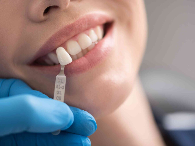 Proces aplikacji licówek: czego możesz się spodziewać podczas wizy - grafika