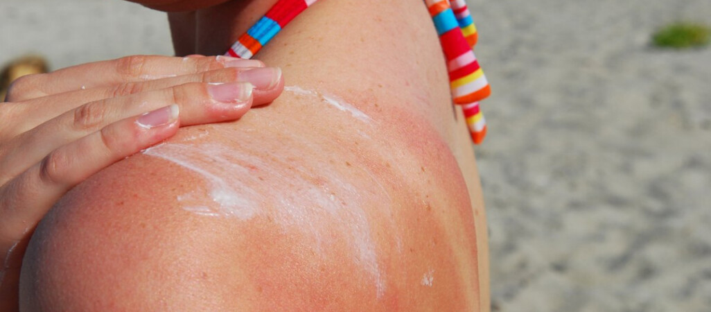 Domowe sposoby na oparzenia słoneczne
