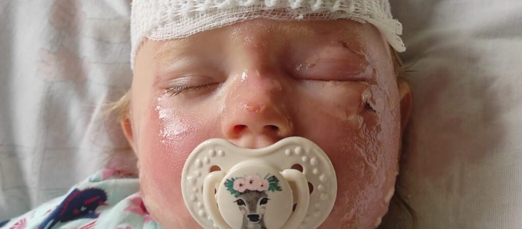 Marcelinka wylała na siebie herbatę. Czeka ją kosztowne leczenie  