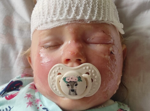 Marcelinka wylała na siebie herbatę. Czeka ją kosztowne leczenie   - grafika