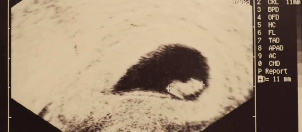 NIK: Pacjentkom, które poroniły, lub urodziły martwe dziecko nie zapewniono prawidłowej opieki