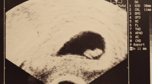 Całkowity zakaz aborcji. Wyrok Trybunału Konstytucyjnego  - grafika