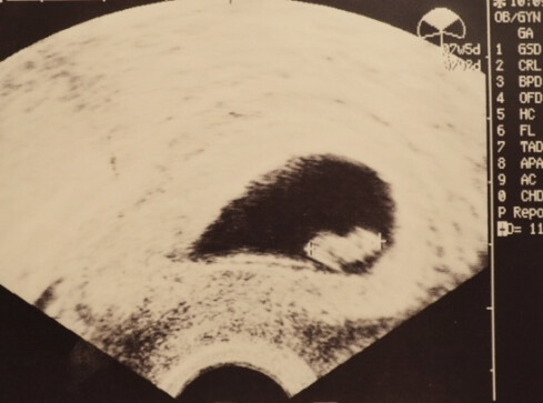 Całkowity zakaz aborcji. Wyrok Trybunału Konstytucyjnego  - grafika